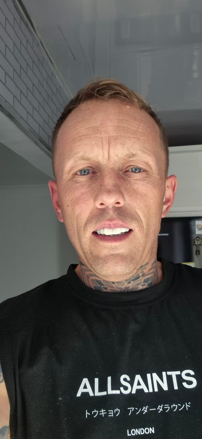 Customer photo review of Click-in Veneers 4.0