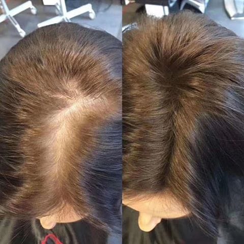Customer photo review of ערכת צמיחת שיער מחדש