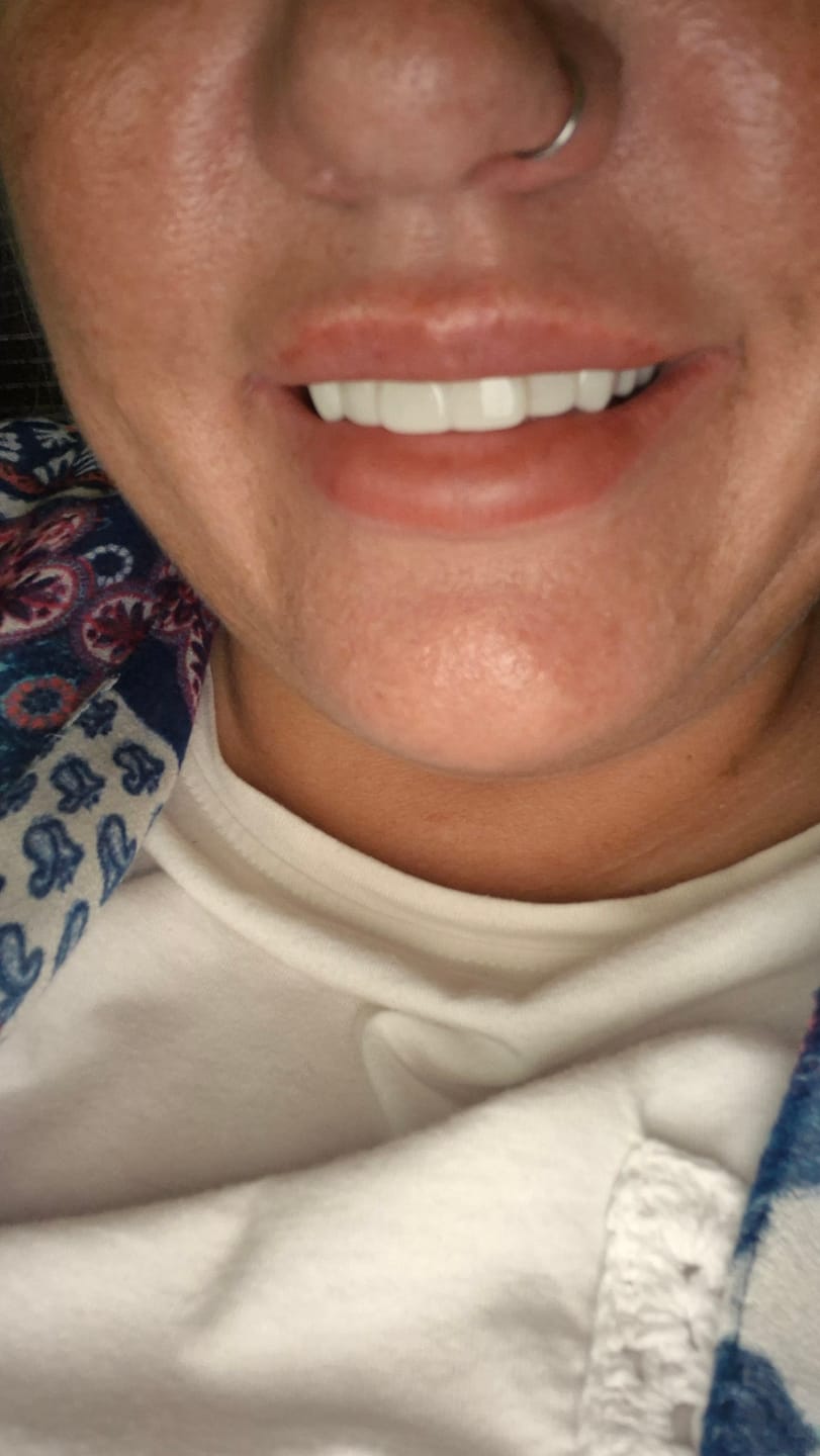 Customer photo review of Click-in Veneers 4.0