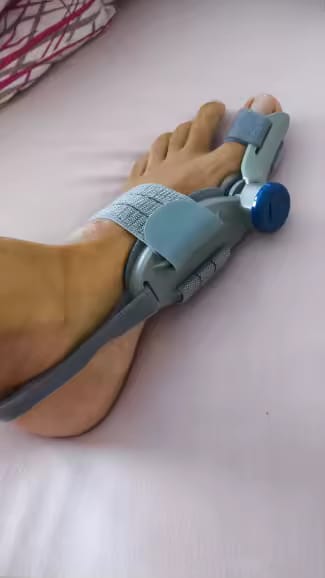 Customer photo review of HalluxAlign™