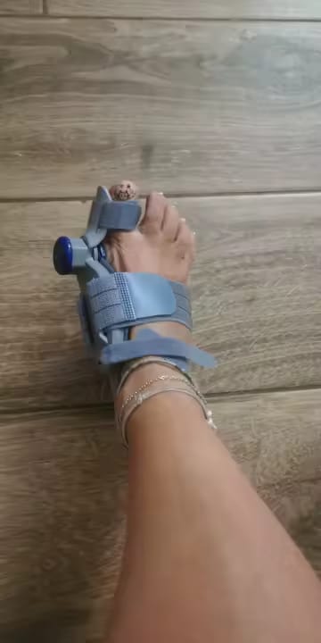Customer photo review of HalluxAlign™