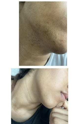 Customer photo review of Iluumi IPL Hair Removal Handset