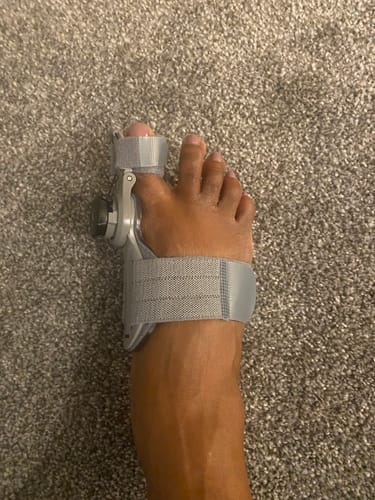 Customer's foot wearing the grey Treatmedy Bunion Fix device on a carpeted floor.
