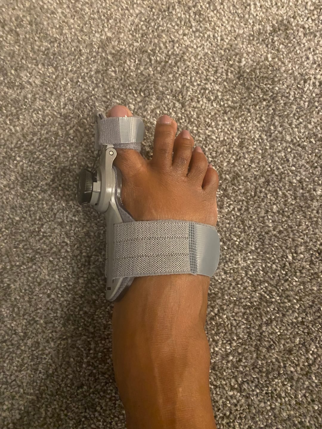 Customer photo review of Treatmedy™ Bunion Fix