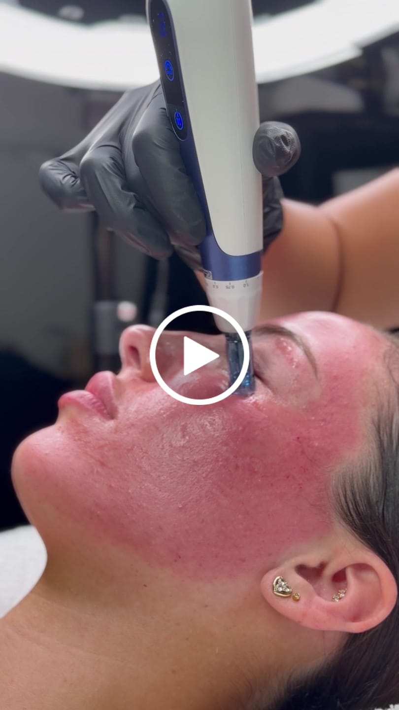 Customer video review of Microneedling Pen Protective Sleeve (200 pcs)