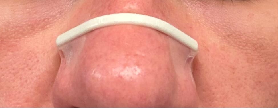 Customer photo review of Second Wind Nasal Strips