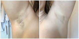 Customer photo review of Iluumi IPL Hair Removal Handset