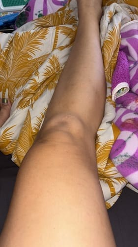 Customer photo review of Iluumi IPL Hair Removal Handset