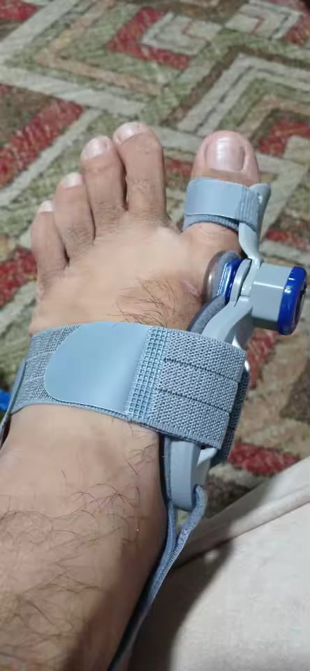 Customer photo review of HalluxAlign™