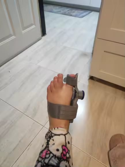 Customer photo review of HalluxAlign™