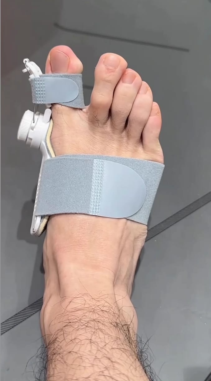 Customer photo review of HalluxAlign™