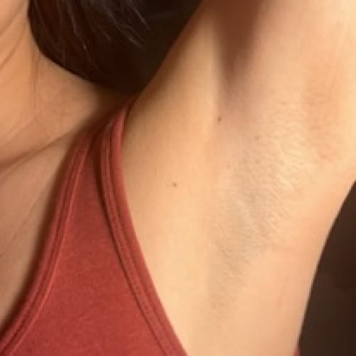 Customer photo review of Iluumi IPL Hair Removal Handset
