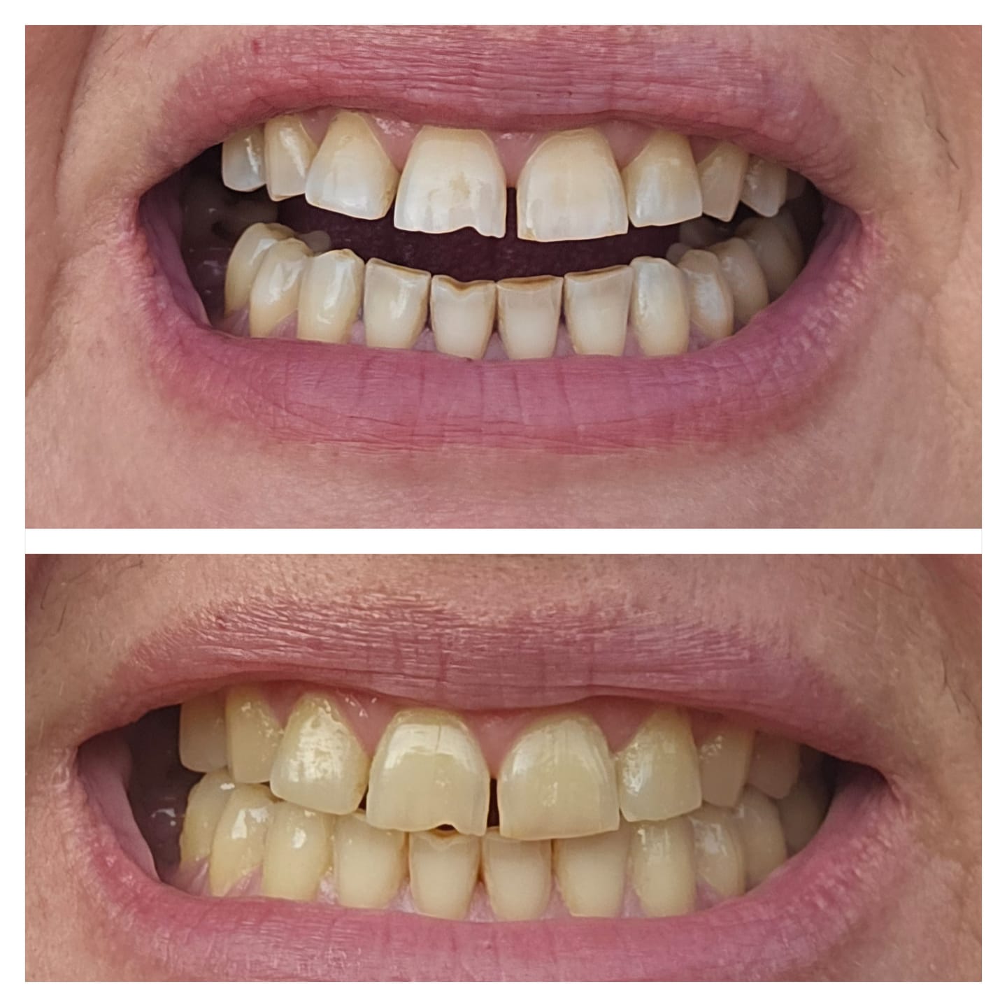 Customer photo review of V24 Violetinės Dantų Balinimo Juostelės