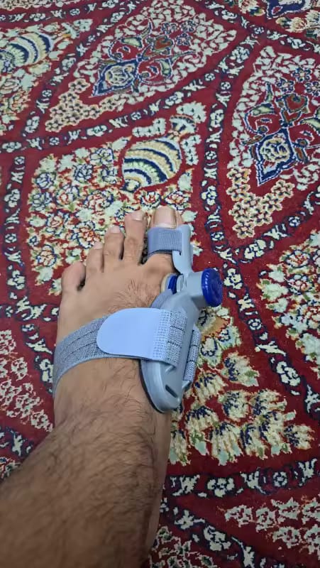 Customer photo review of HalluxAlign™