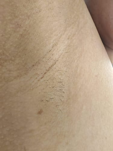 Customer photo review of Iluumi IPL Hair Removal Handset