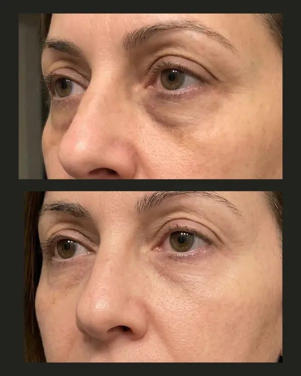 Customer photo review of Σύστημα Περιποίησης Ματιών Labbok - Μαύροι Κύκλοι & Ρυτίδες, Άμεση Σύσφιξη σε 30 Λεπτά