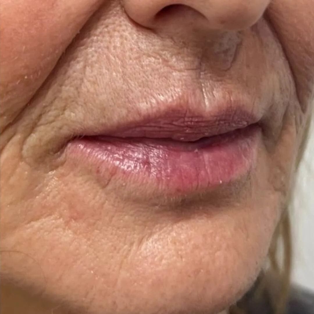 Customer photo review of Salutly • Rullo Microneedle Effetto Filler