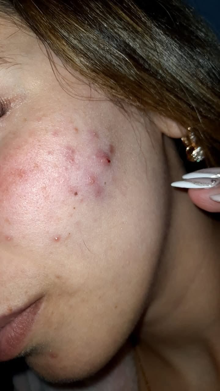 Customer photo review of [ Peaux Sensibles ] ACIDE HYALURONIQUE + NIACINAMIDE ULTRA PURE · HIGH POTENCY