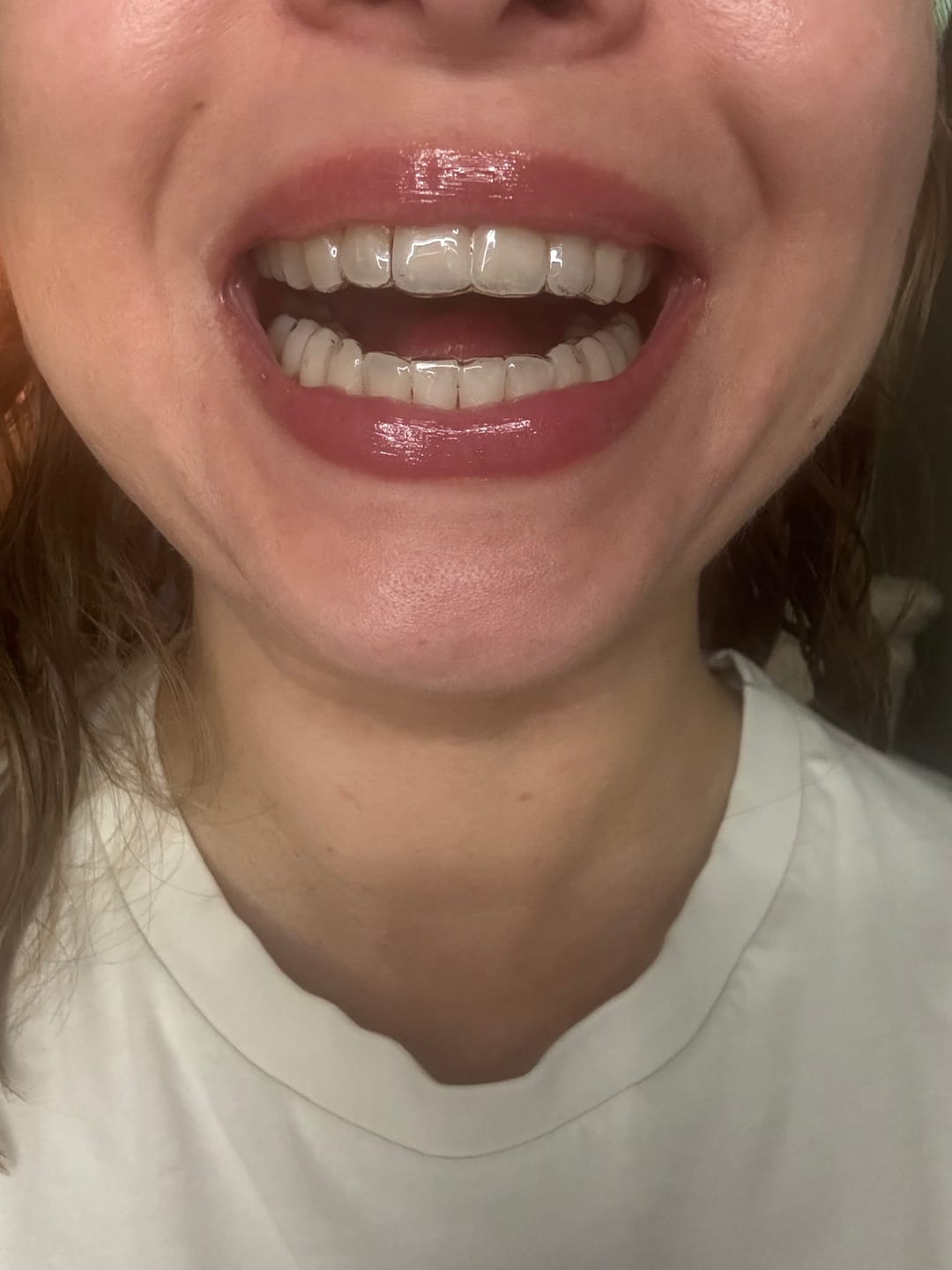 Customer photo review of Essix Retainers