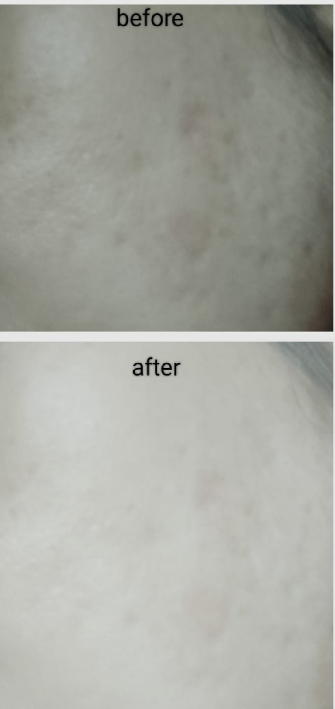 Customer photo review of NiaRonic Serum (Pore Minimizing)