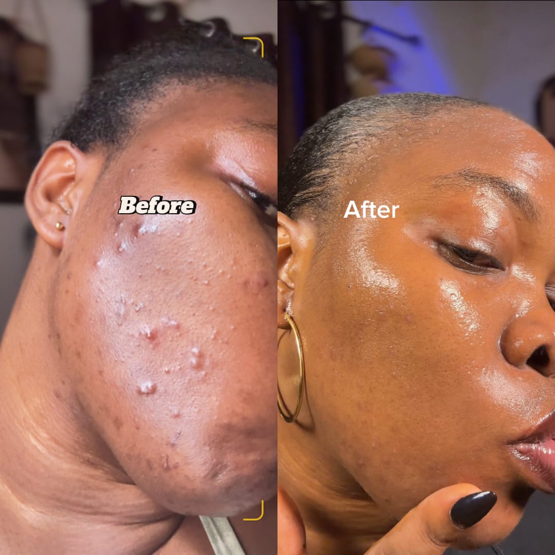 Customer photo review of Pure Kojic Acid Skin Brightening Soap (2 Bars)