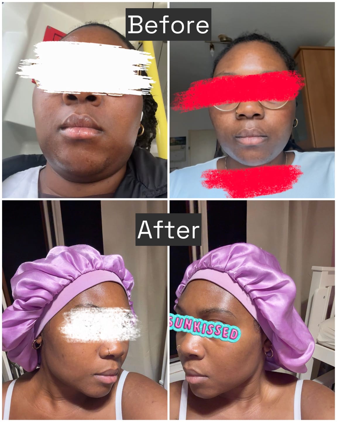 Customer photo review of Exfoliating Body & Face Bar – 3% Salicylic Acid + 10% Sulphur Soap