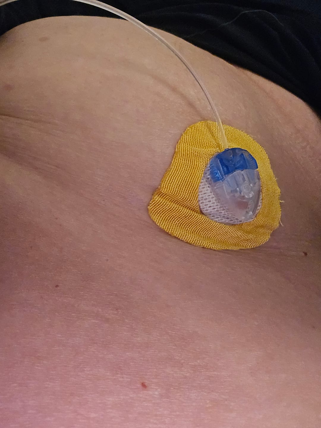 Customer photo review of Skin Grip Original - Dexcom G7 & Stelo Adhesive Patches (With Cutout)