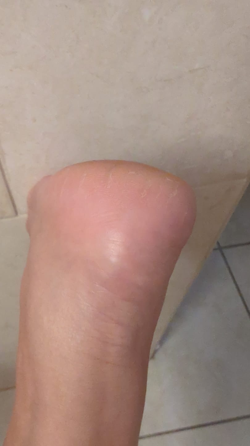 Customer photo review of Foot Balm