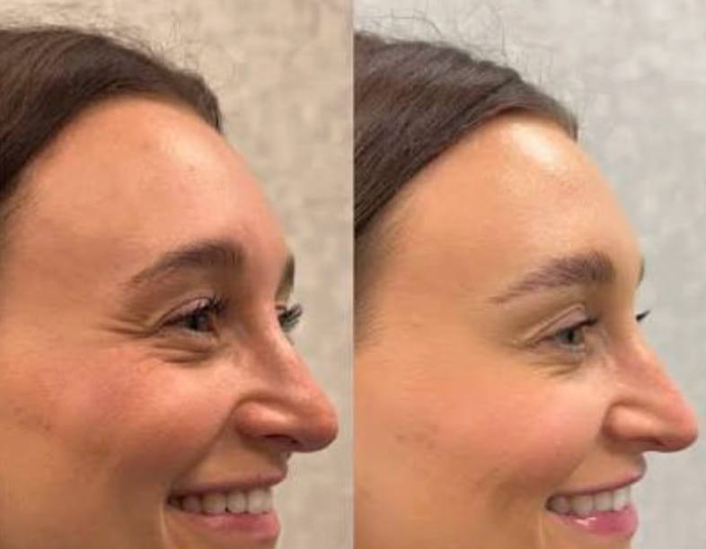 Customer photo review of Luelle Wrinkle Patches