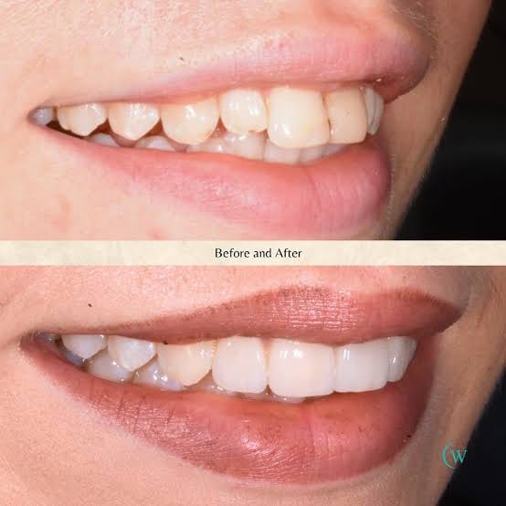 Customer photo review of Teeth Whitening Powder