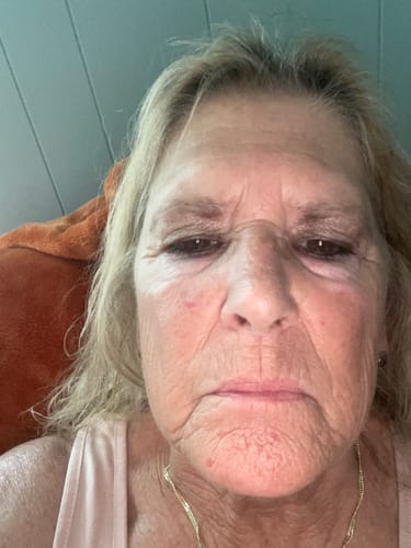 Reviewer's face after using The Micro Infusion System for six treatments, showing improved skin texture.