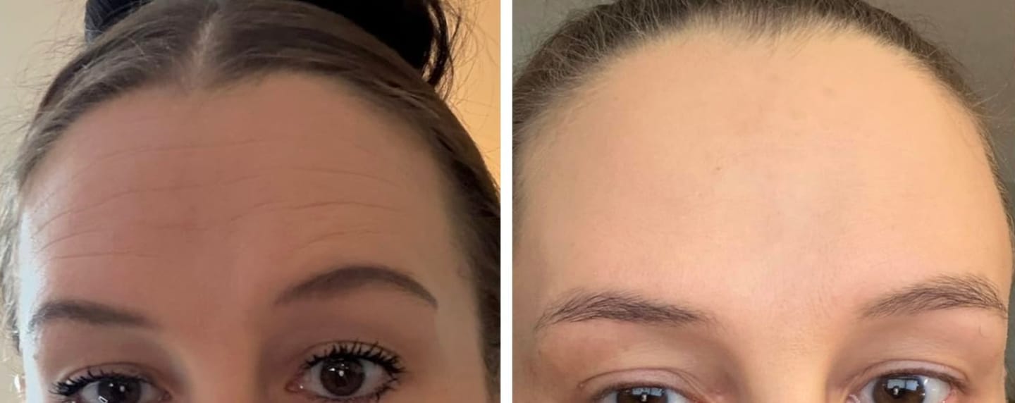 Customer photo review of Luelle Wrinkle Patches