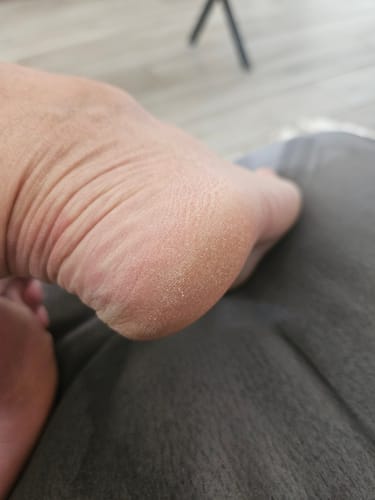 Customer photo review of Râpe Anti-Callosités Vantyx™ PRO