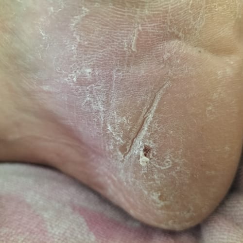 Customer photo review of Râpe Anti-Callosités Vantyx™ PRO