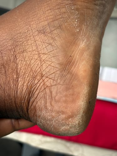Customer photo review of Râpe Anti-Callosités Vantyx™ PRO