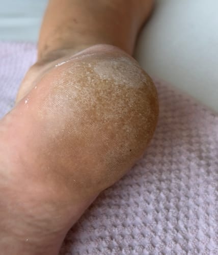 Customer photo review of Râpe Anti-Callosités Vantyx™ PRO