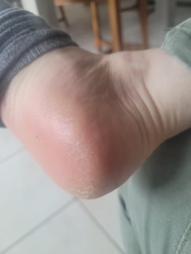 Customer photo review of Râpe Anti-Callosités Vantyx™ PRO