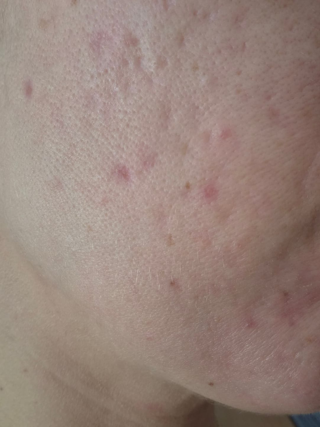 Customer photo review of A CONTROL - ACNÉ HORMONAL & RESISTENCIA A LA INSULINA