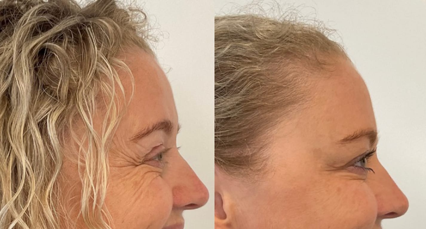 Customer photo review of Luelle Wrinkle Patches