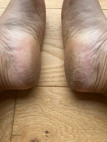 Customer photo review of Râpe Anti-Callosités Vantyx™ PRO