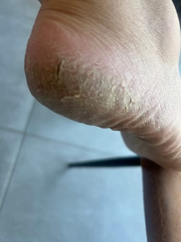 Customer photo review of Râpe Anti-Callosités Vantyx™ PRO