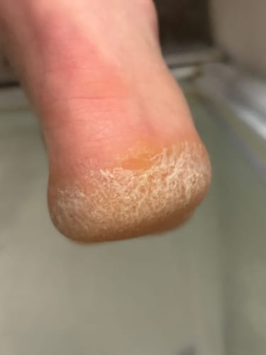 Customer photo review of Râpe Anti-Callosités Vantyx™ PRO