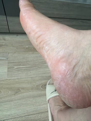 Customer photo review of Râpe Anti-Callosités Vantyx™ PRO