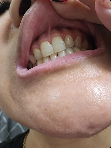 Customer photo review of LYSS Oil Pulling - kokosový olej na zuby