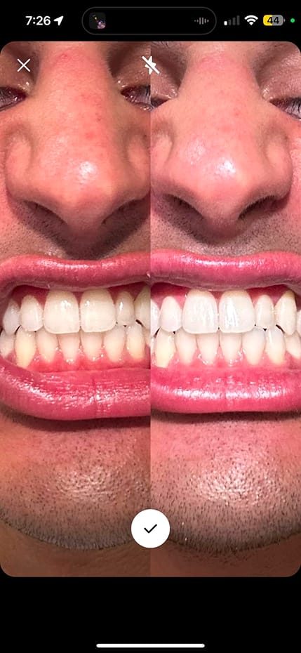 Customer photo review of LYSS Oil Pulling - kokosový olej na zuby