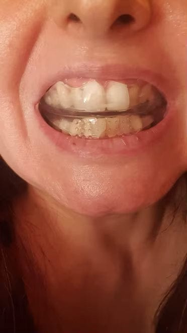 Customer photo review of Ortmedy™ Align