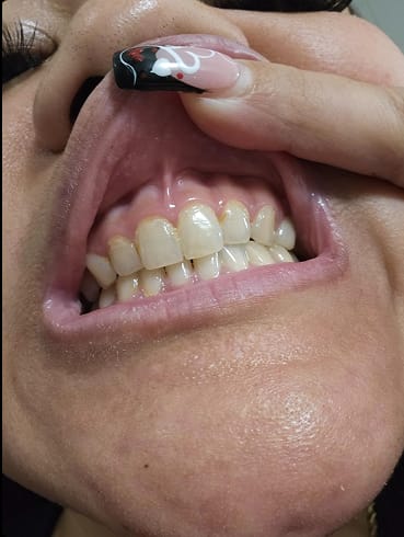 Customer photo review of LYSS Oil Pulling - kokosový olej na zuby