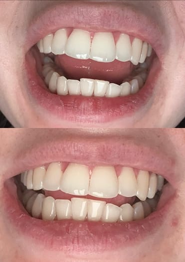 Customer photo review of LYSS Oil Pulling - kokosový olej na zuby