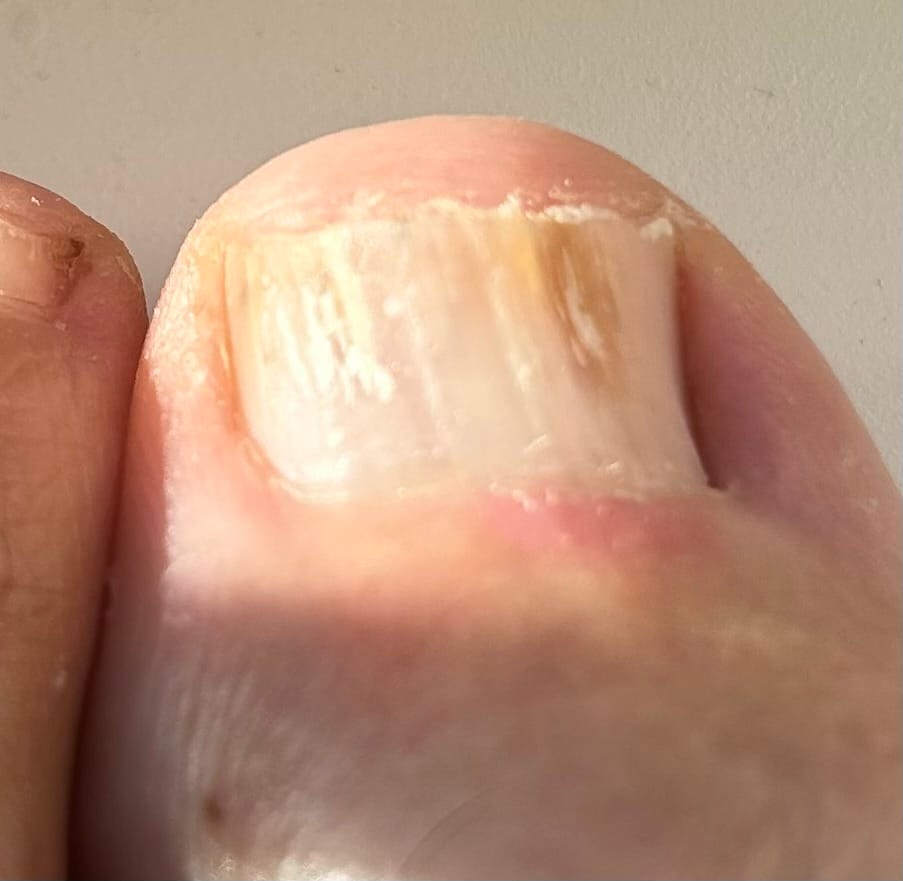 Customer photo review of VELCURA™ Fungal Nail Patches