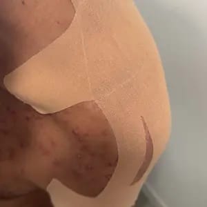 Customer photo review of Supporto Spalla Impermeabile con Tape Kinesiologico Pretagliato